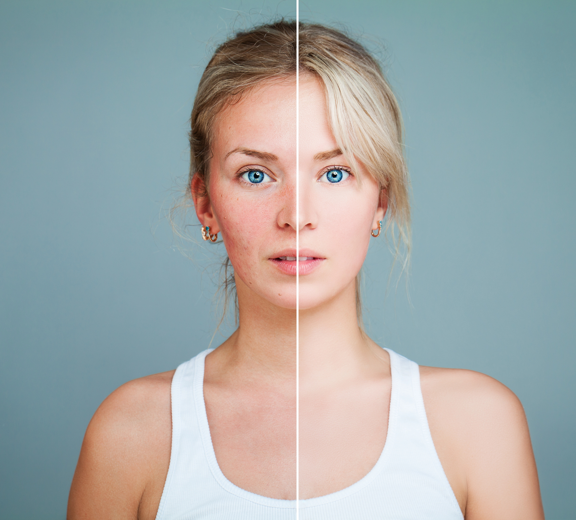 Laser Treatment for Rosacea