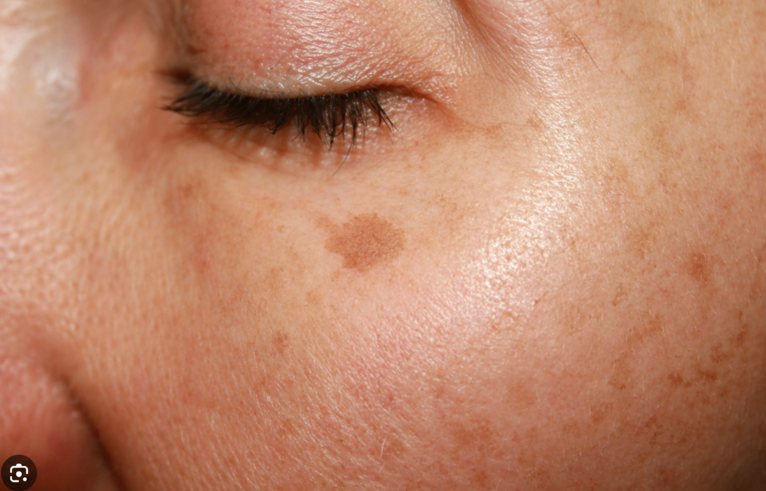 LASER AGE SPOT REMOVAL